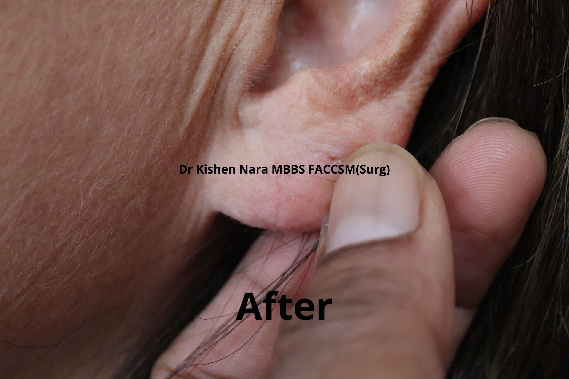 best top ear lobe repair cosmetic surgery melbourne tasmania