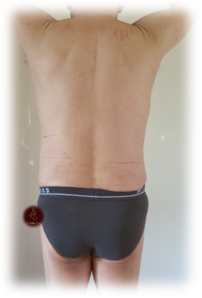 top before after lipo waist belt tummy tas, lipo waist cosmetic surgeon 360 liposculpture melbourne cost price liposuction