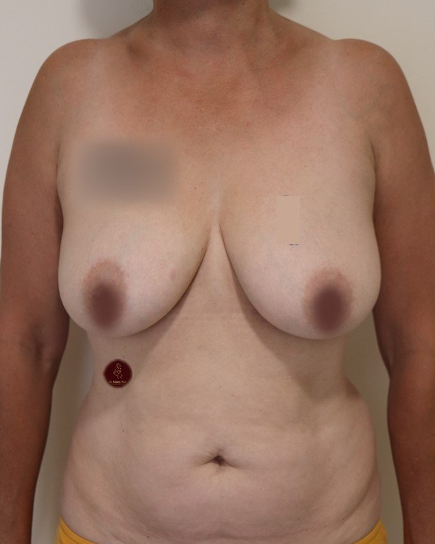 saggy breasts tissues before after