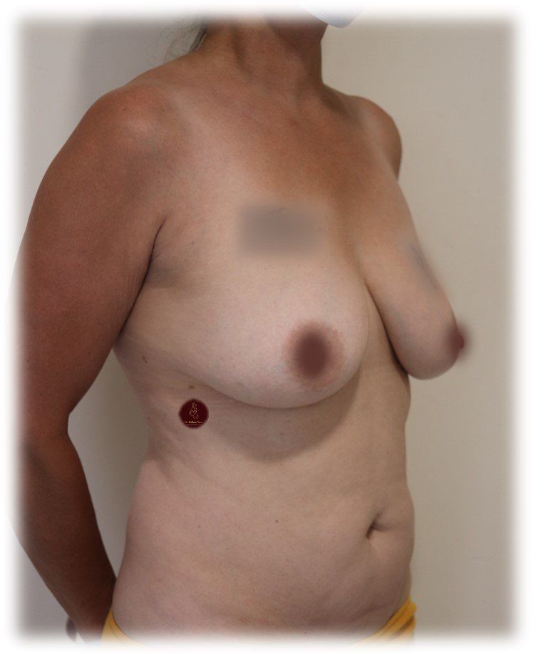 Before after top surgeon lifted breasts