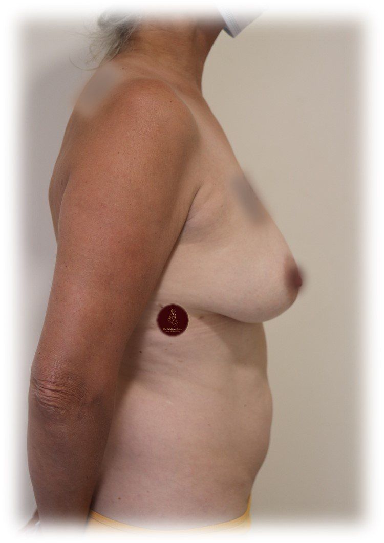 breasts side view before surgery great doctor