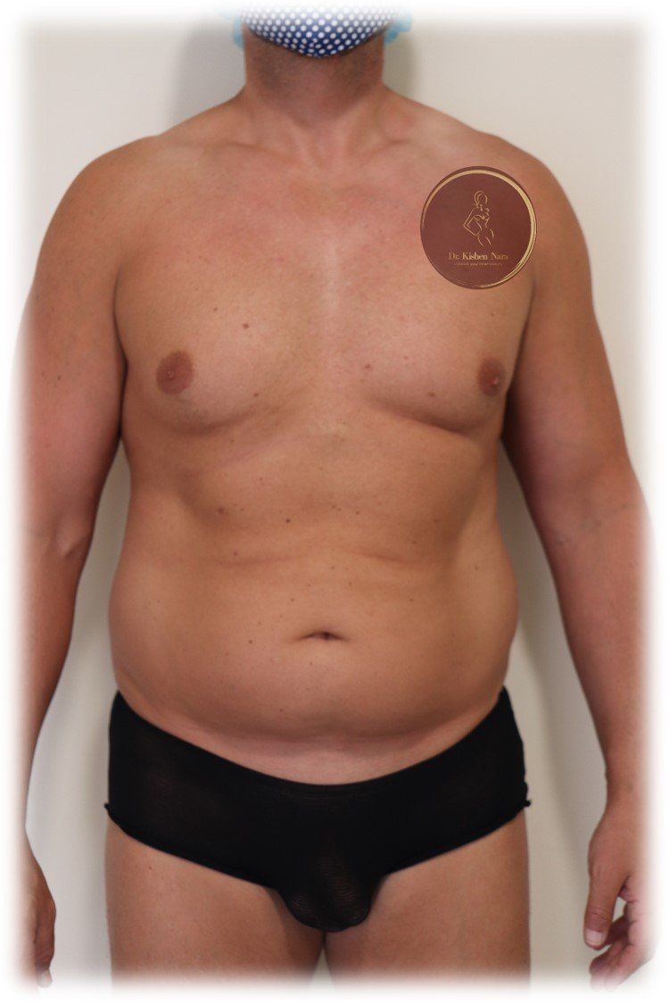 best before after cosmetic lipo waist back top cosmetic surgeon tas tasmania melbourne liposuction sculpture price cost