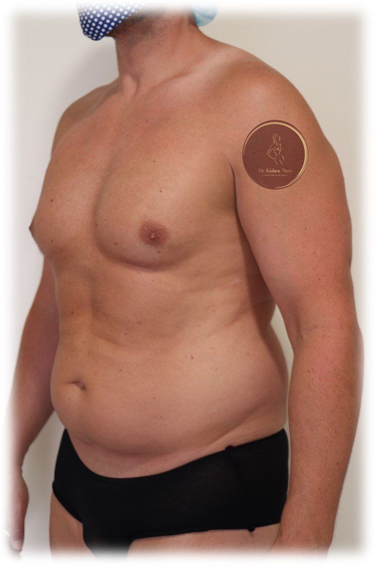 best lipo man before after athletic liposuction price cost tasmania melbourne liposculpture cosmetic plastic surgeon