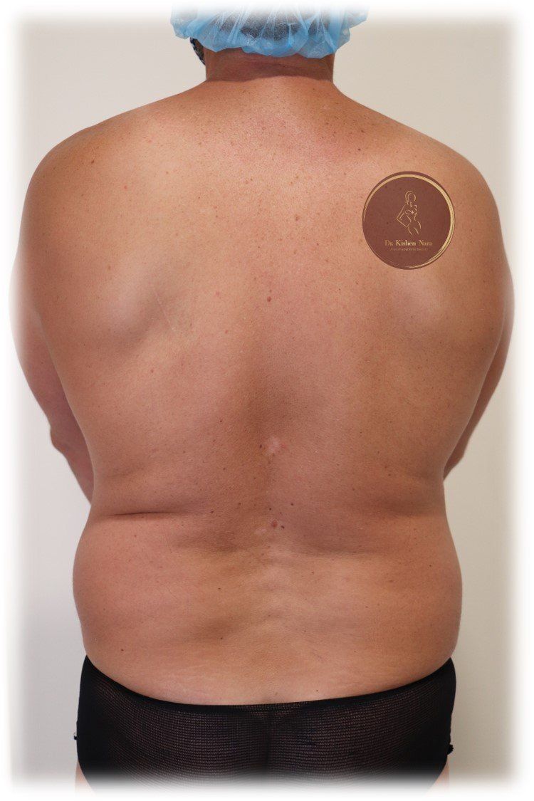 liposuction lipo back man best liposculpture tas tasmania melbourne price cost cosmetic surgeon recovery before after