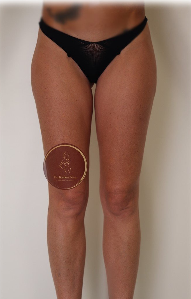 top thigh gap leg enhancement liposuction lipo