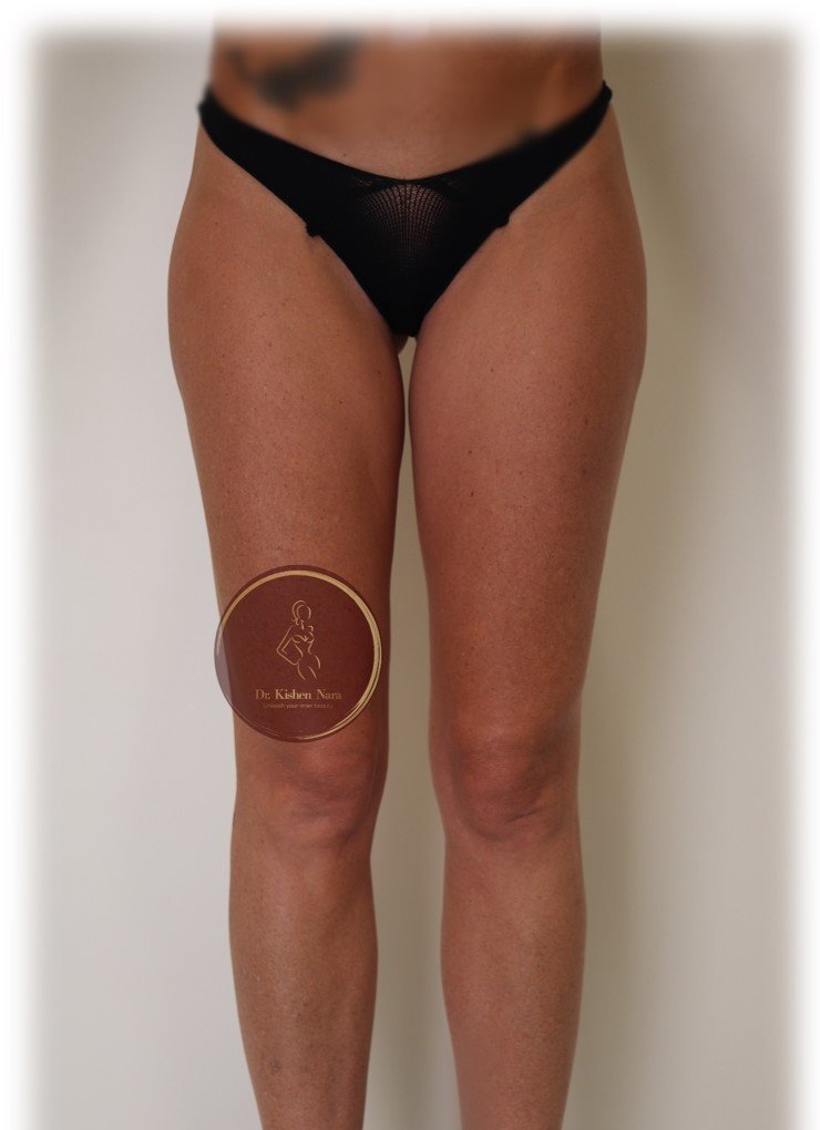 cosmetic surgery thigh gap enhancement lipo 360 top liposuction melbourne tas tasmania price cost thighs
