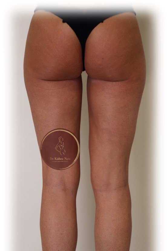 women woman lipo thighs tasmania melbourne best cosmetic surgeon inner outer thigh best price cost
