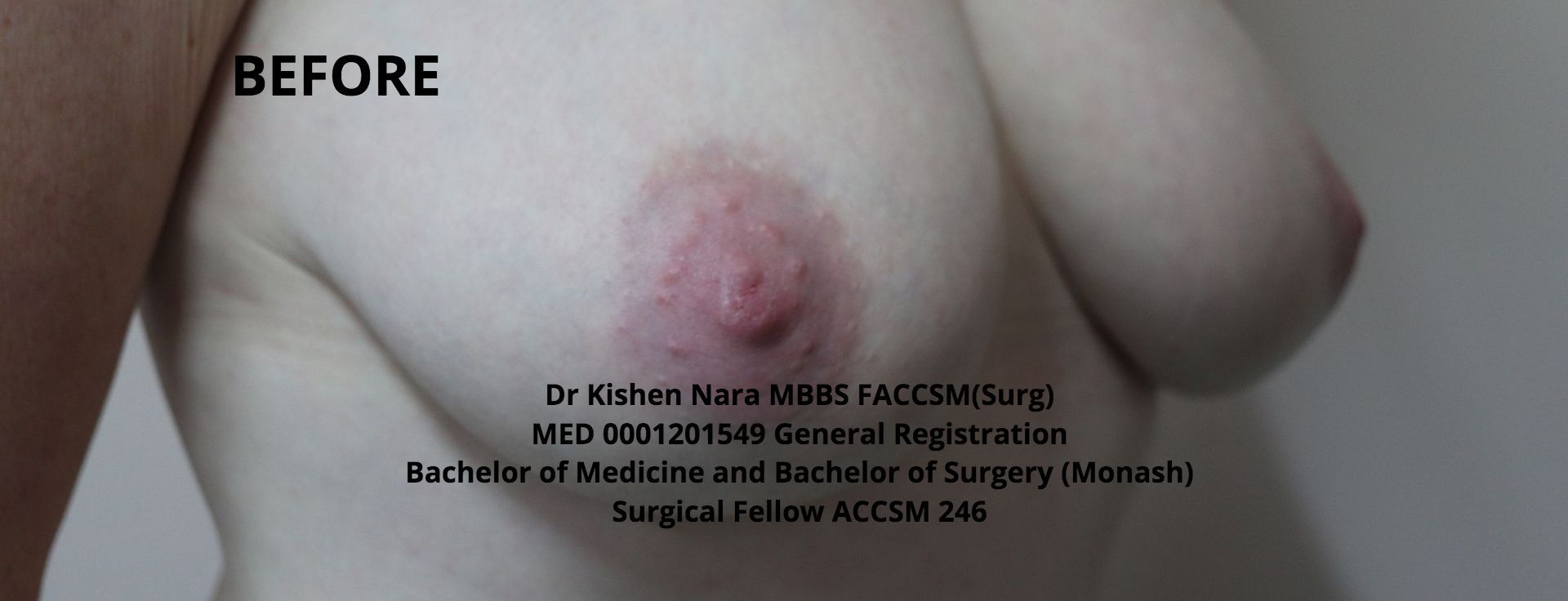 Nipple inversion causes correction surgery near me Melbourne Tasmania Hobart devonport burnie elwood st kilda brighton 