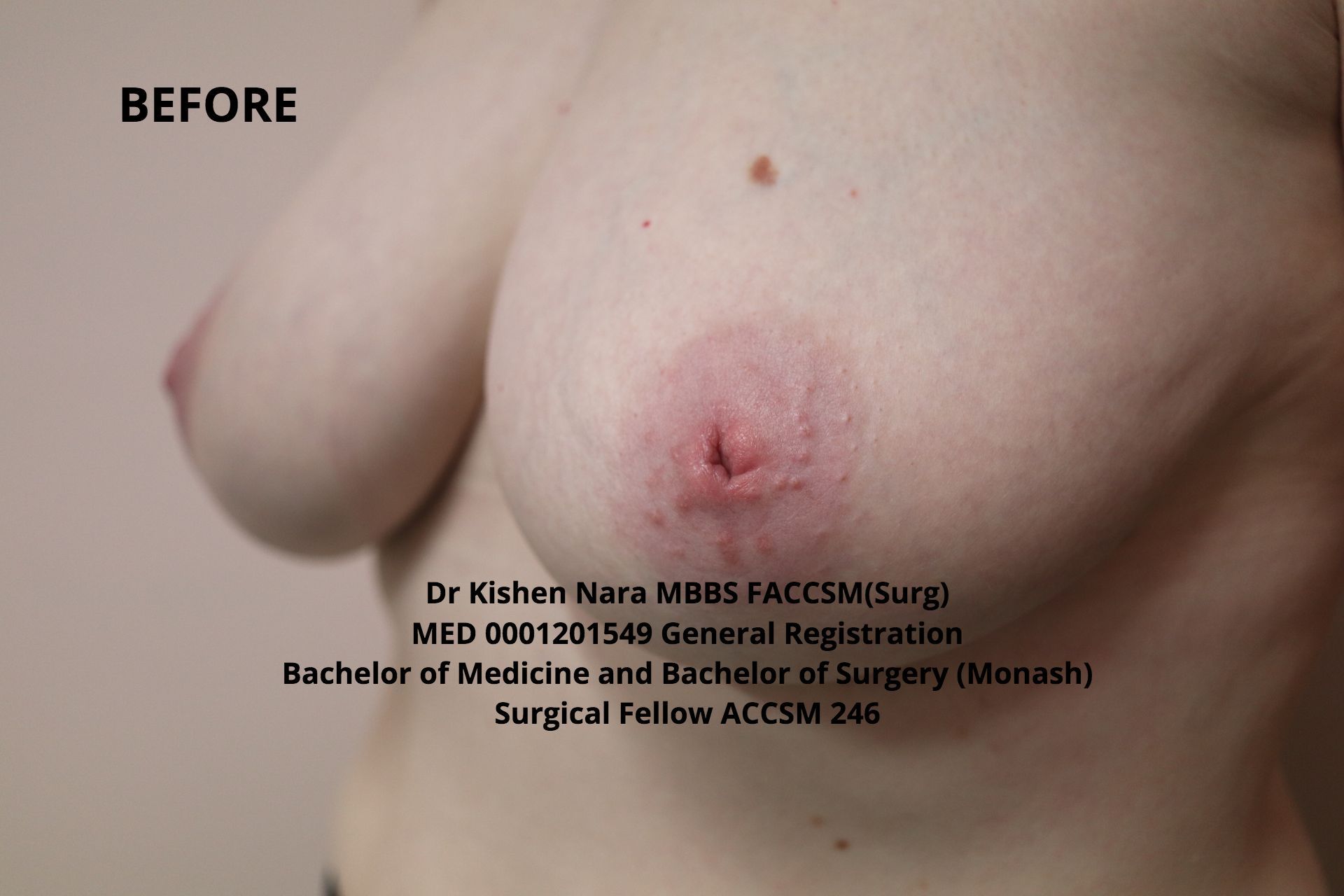 top nipple inversion surgery melbourne tasmania elwood hobart burnie cosmetic aesthetic breast