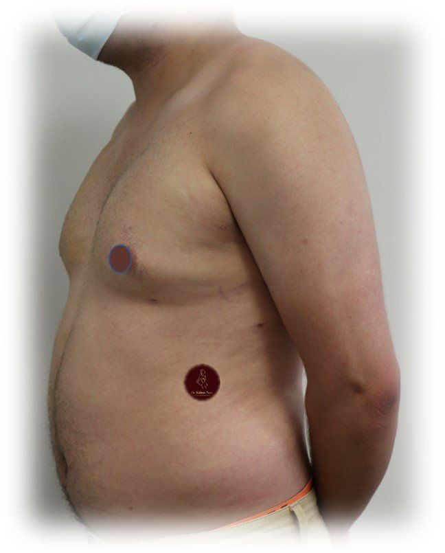 manboobs manboob surgery lipo 360 liposculpture sculpture chest gynaecomastia tasmania melbourne  top cosmetic surgeon