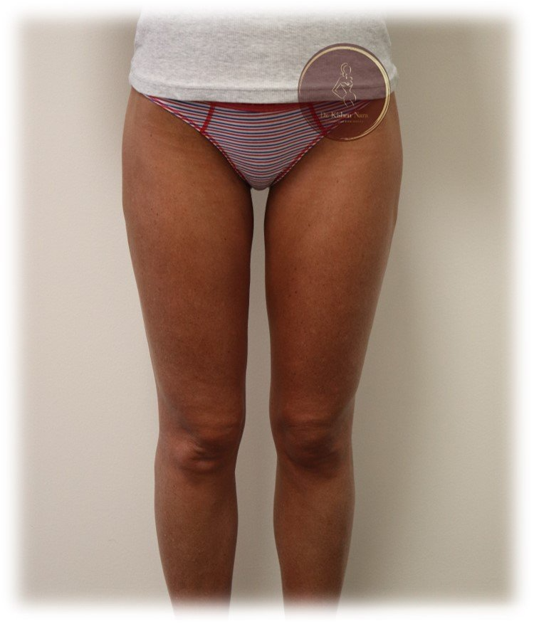 best thigh liposuction lipo tasmania melbourne best cosmetic surgeon liposculpture price cost