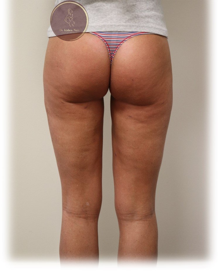 lipo tasmania thigh gap legs smaller narrow, liposuction melbourne, lipo hips, hip dip best cosmetic surgeon cost price