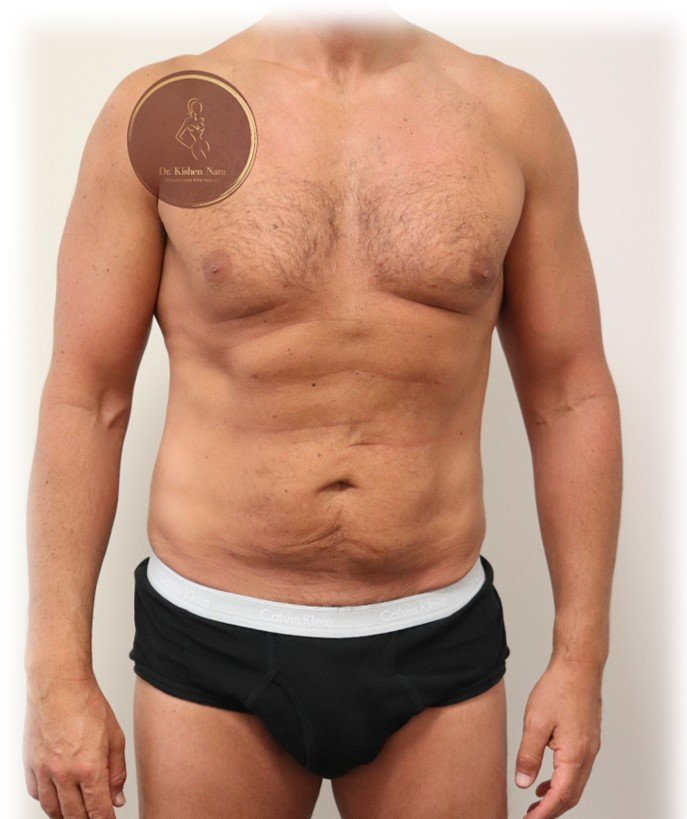 top strong liposuction definition muscular etching lipo cost liposculpture price tasmania melbourne