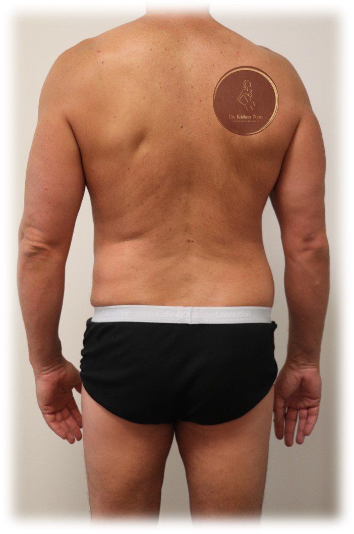 top best results liposuction back lipo 360 tasmania melbourne tas price cost liposculpture cosmetic surgeon area