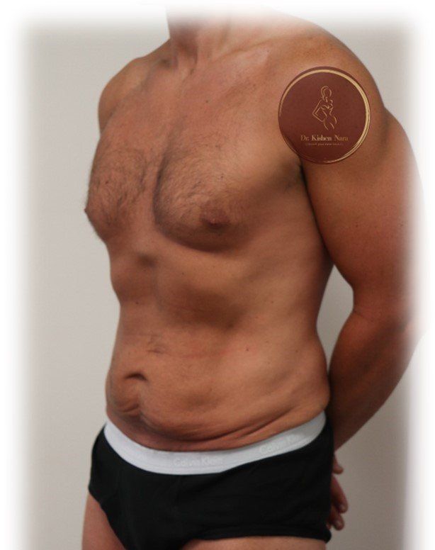 top cosmetic surgeon liposuction man athletic lipo waist 6 abs definition sculpt cost liposculpture
