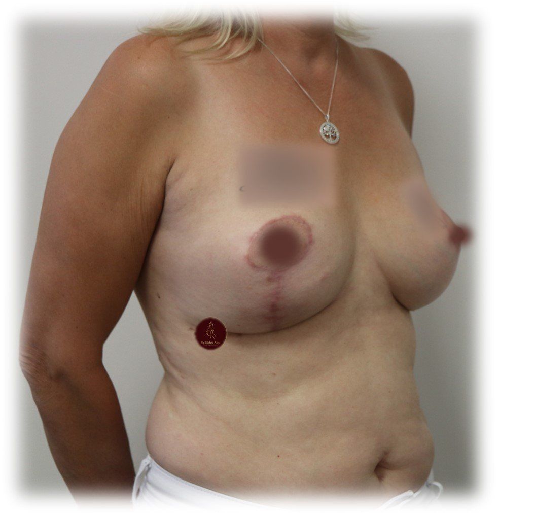 breast lift dr kishen nara best surgeon tasmania melbourne