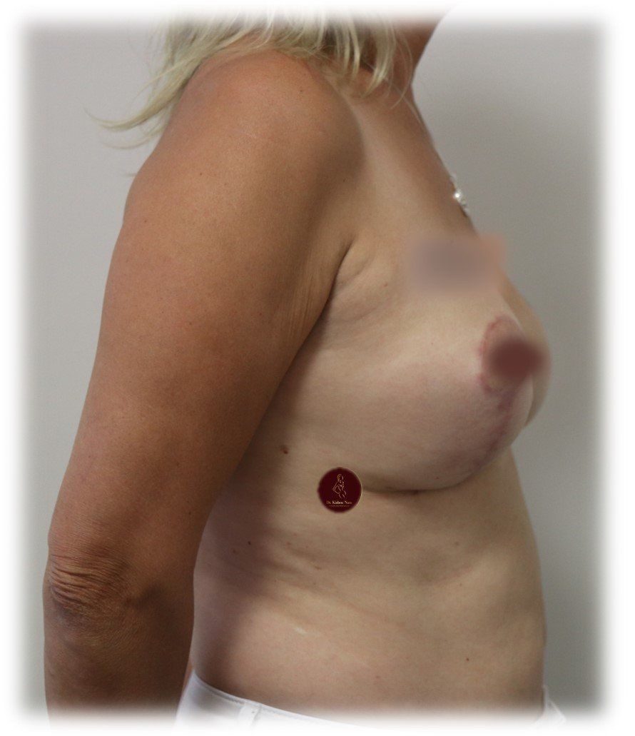 before after best cosmetic surgeon tasmania hall findlay breast lift mastopexy reduction