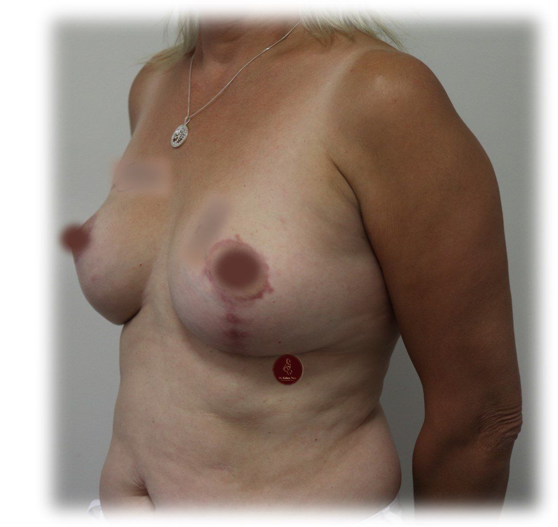 dr kishen nara revaesthetic breast lift mastopexy stages