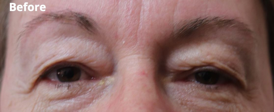 top blepharoplasty eyelid surgery Melbourne Tasmania before after gallery