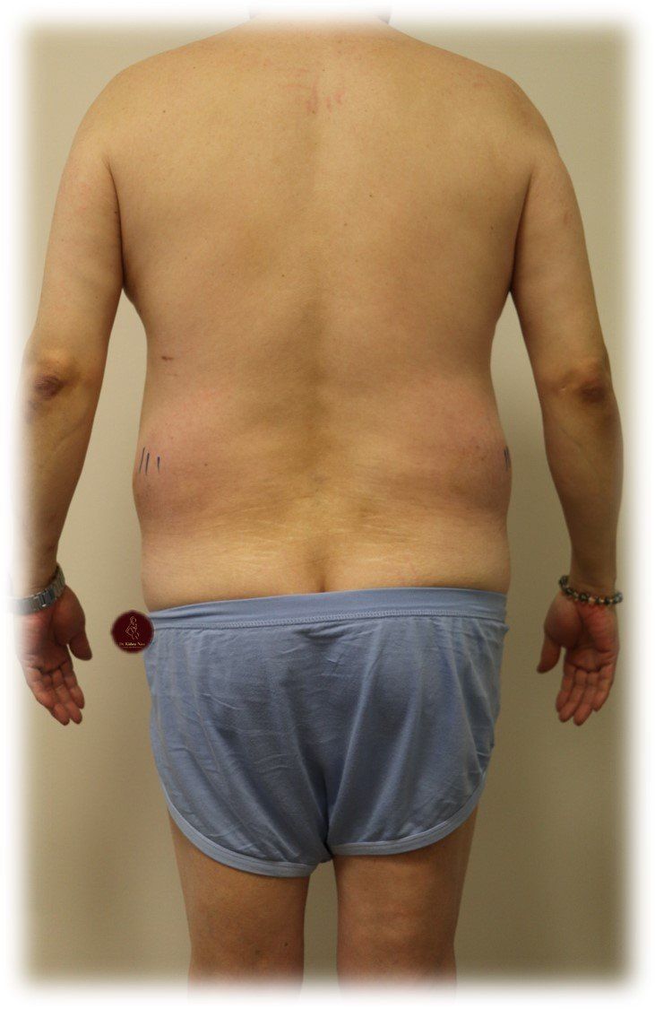 tas lipo back  waist before after melbourne melb lipo 360 waist tummy best cosmetic surgeon