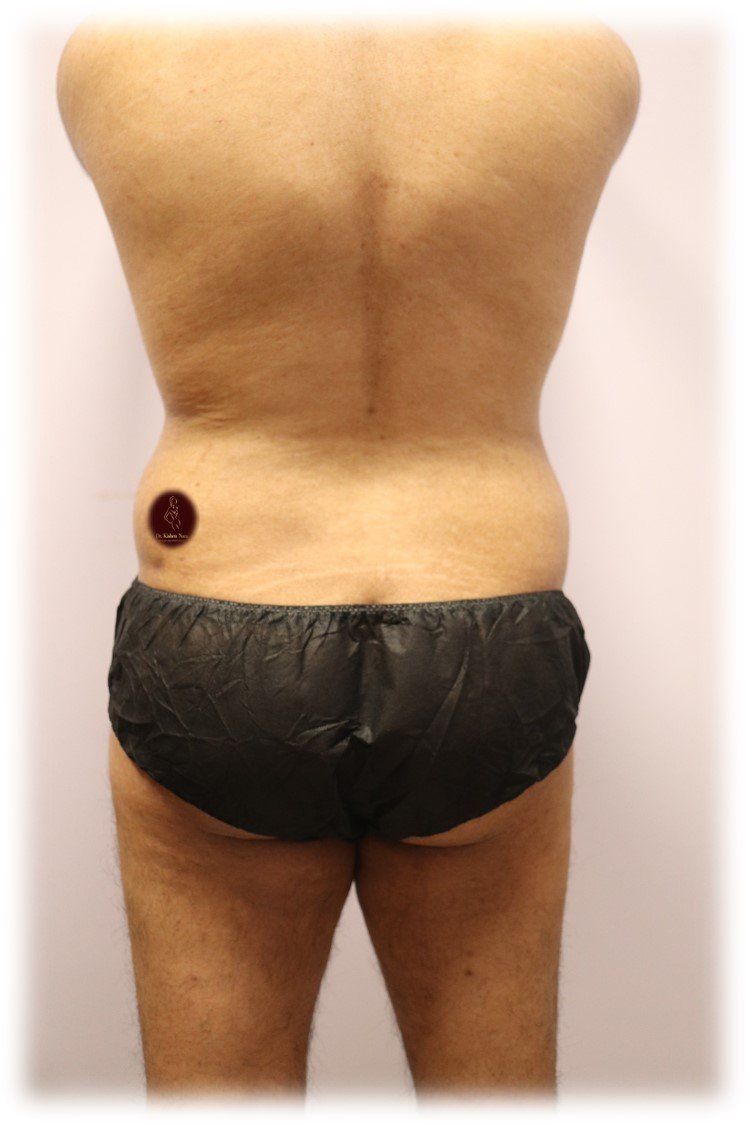 best slim look man lipo back waist plastic