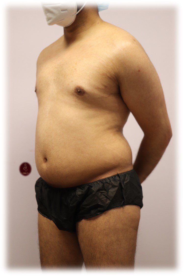 ab lipo waist back tas tasmania melbourne liposuction liposculpture 360 abdomen tummy top cosmetic surgeon before after