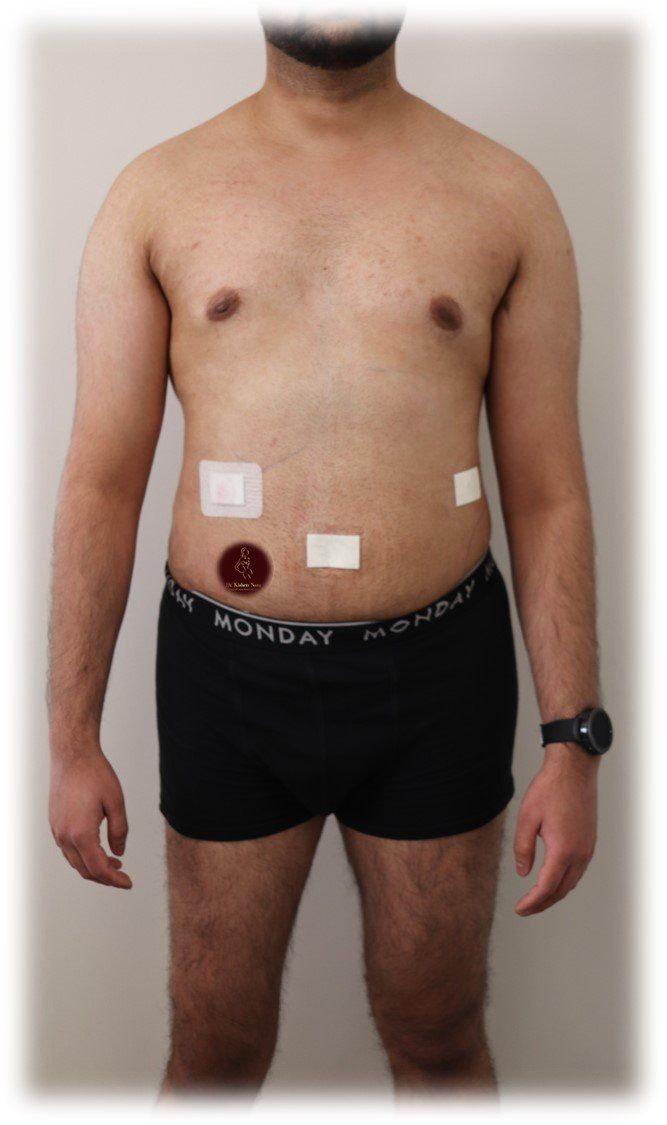 top tasmania lipo waist back tummy ab before after melbourne liposculpture best before after gallery price liposuction