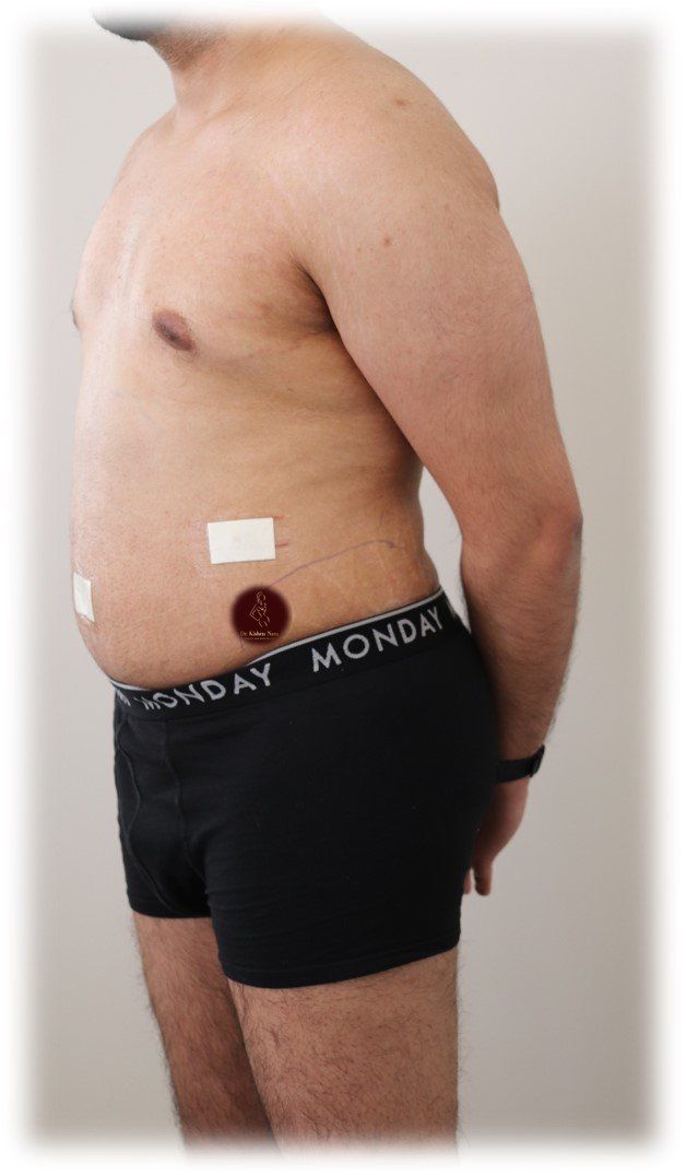 lipo 360 belt waist abdomen best cosmetic surgeon liposculpture before after liposuction recovery cost