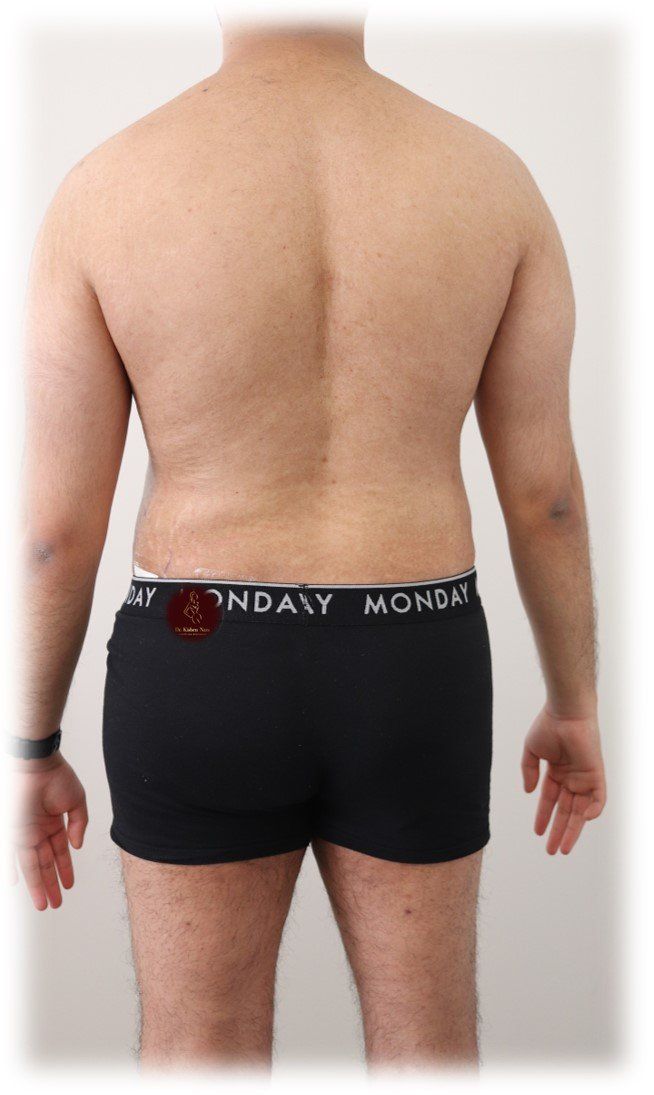 top slender man lipo belt, lipo waist, lipo hips, hip dip