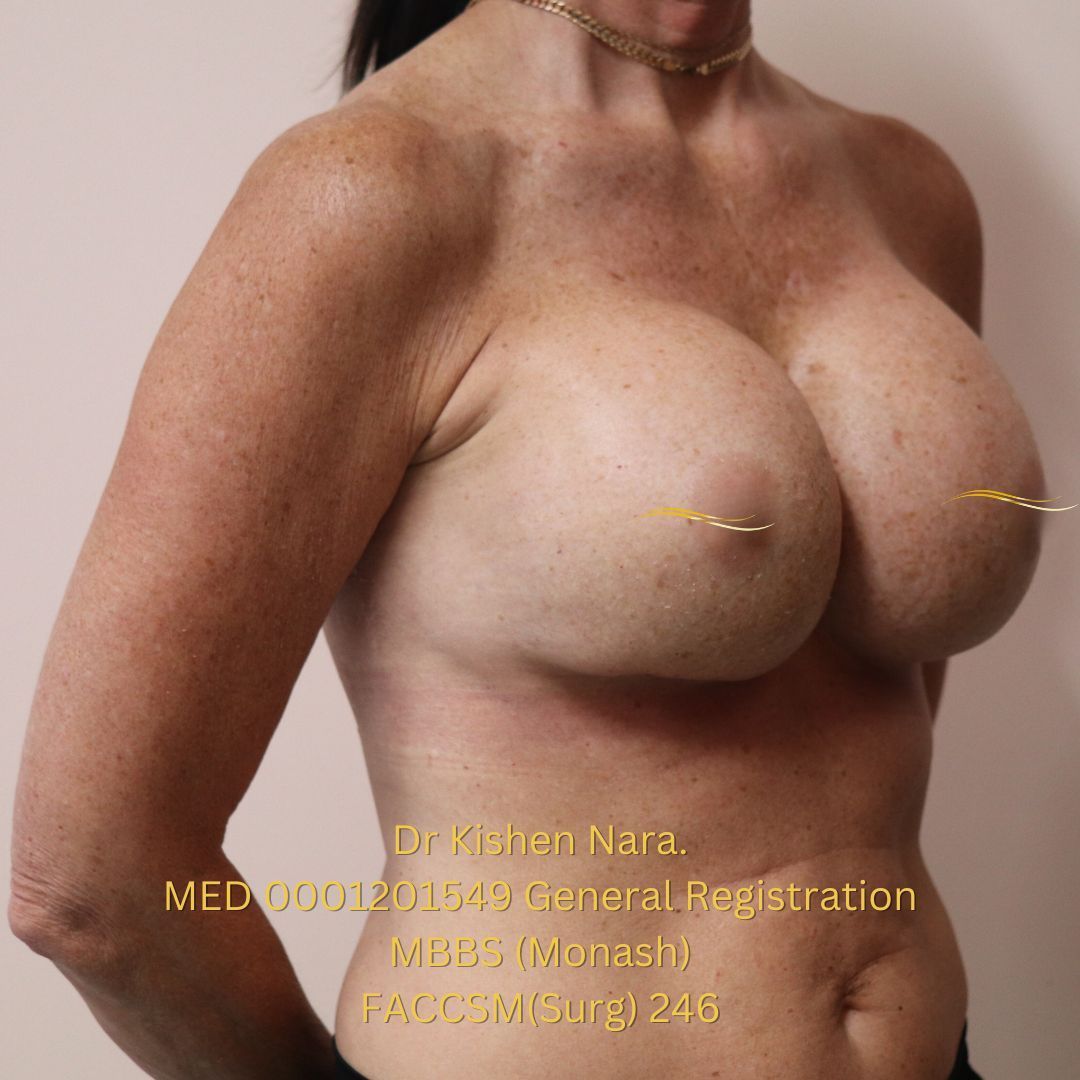Best expert breast implants surgery surgeon Melbourne Tasmania Mel before after