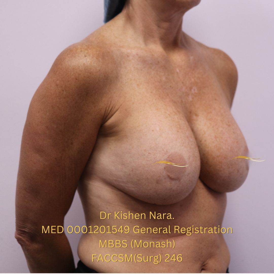 Top cosmetic surgeon breast surgery implants Melbourne Tasmania