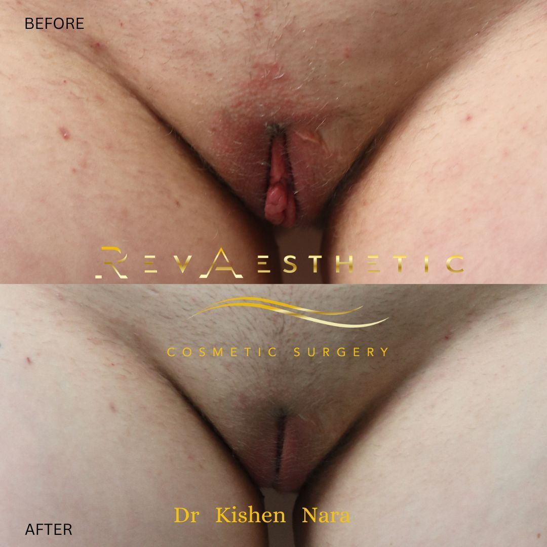 top before after gallery labiaplasty surgery cosmetic labia minora clitoral hood reduction melbourne tasmania dr nara