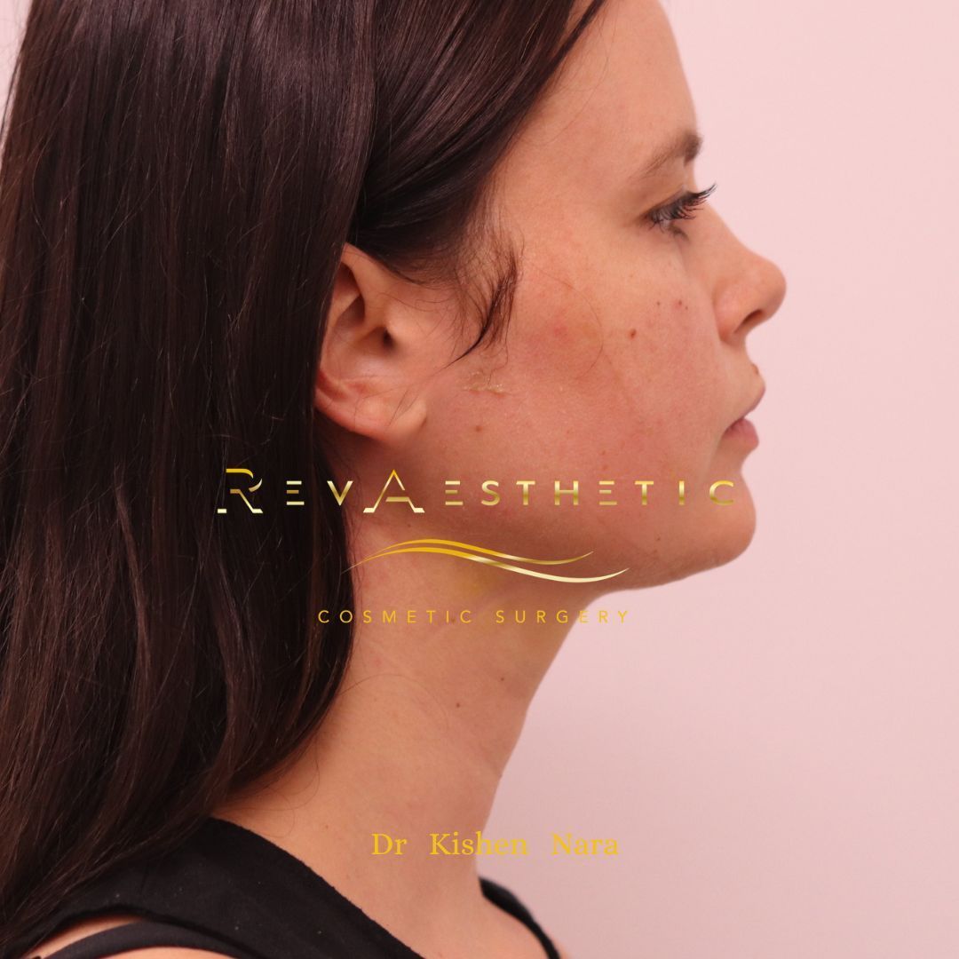 1 week after Submental Liposuction performed by Dr Nara in Melbourne and Hawthorn.