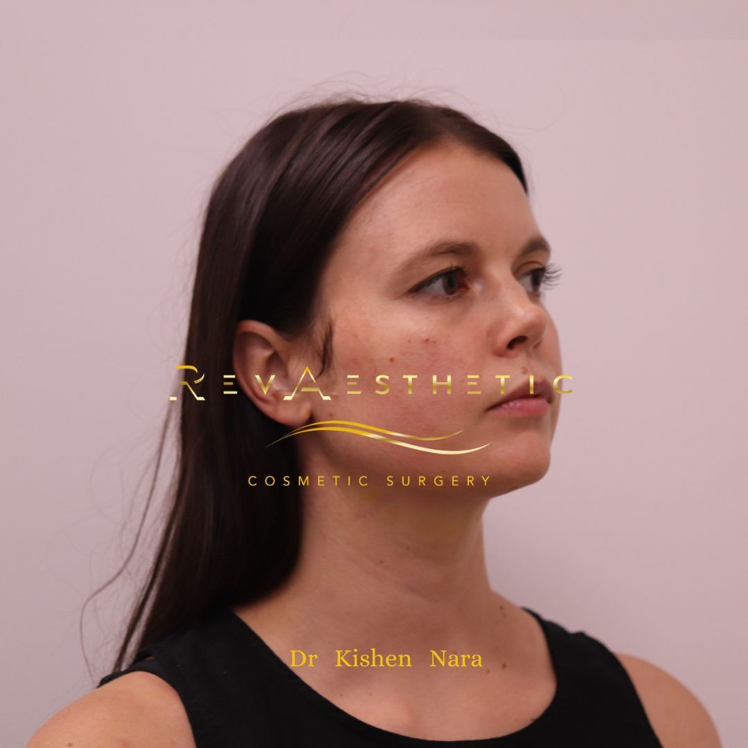 After liposuction of the jawline and neck by Dr Nara in Melbourne and Heyington.