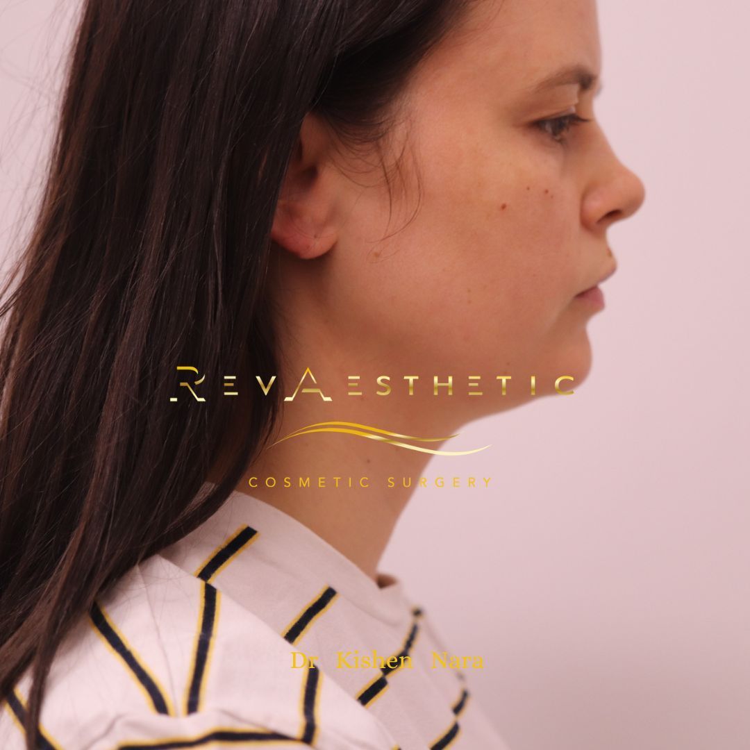 Before Liposuction Jawine and Neck in Melbourne and Kew by Dr Kishen Nara.