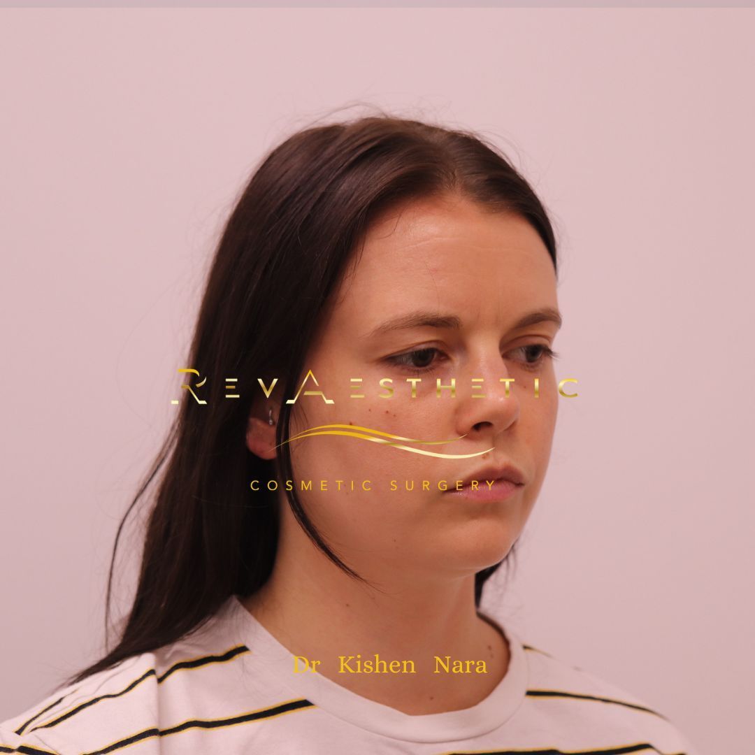 Before Neck liposuction in Melbourne and Collingwood by Dr Nara.