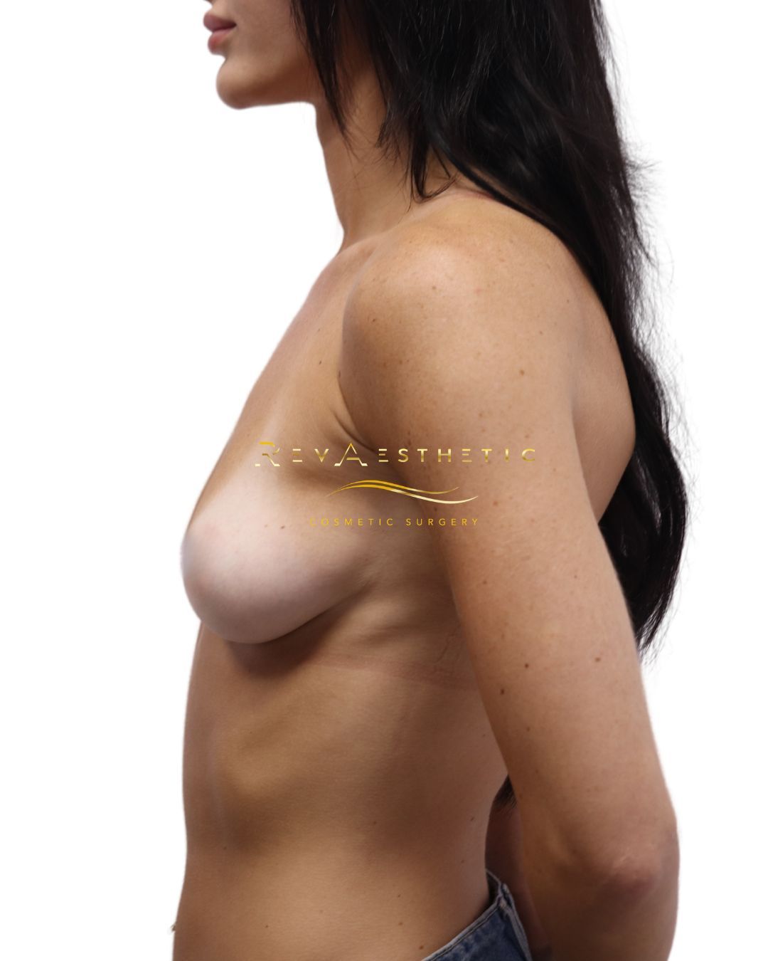 Top quality cosmetic surgery breast augmentation implants chadstone melbourne, armdale, ashwood, glen iris, toorak, brighton, elwood