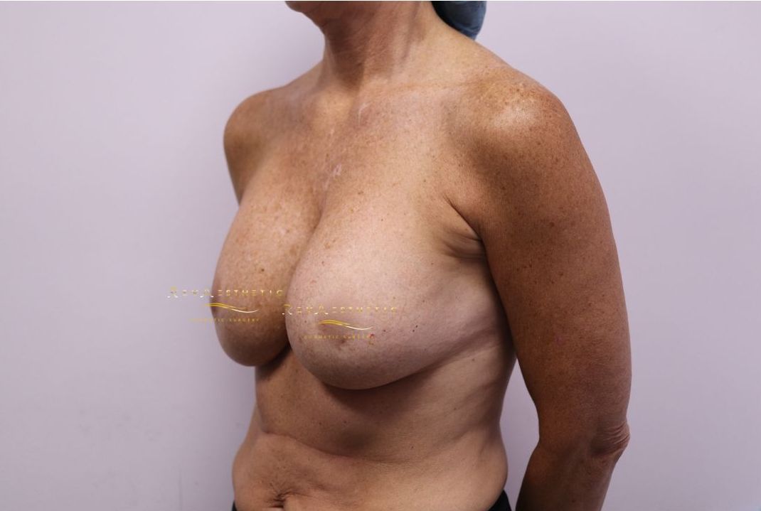 Best before after gallery breast implants top cosmetic surgeon Melbourne Tasmania