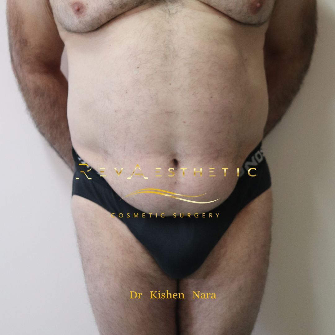 Before tummy Lipo 360 by Dr Nara at RevAesthetic in Melbourne front view