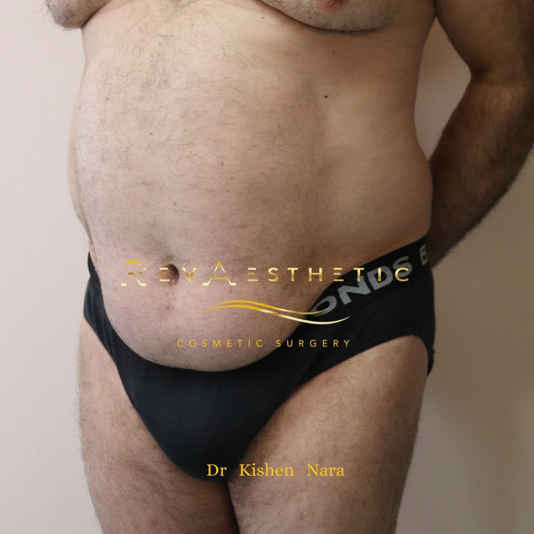 Before liposuction 360 technique by Dr Nara in Melbourne including Malvern East and Armdale 