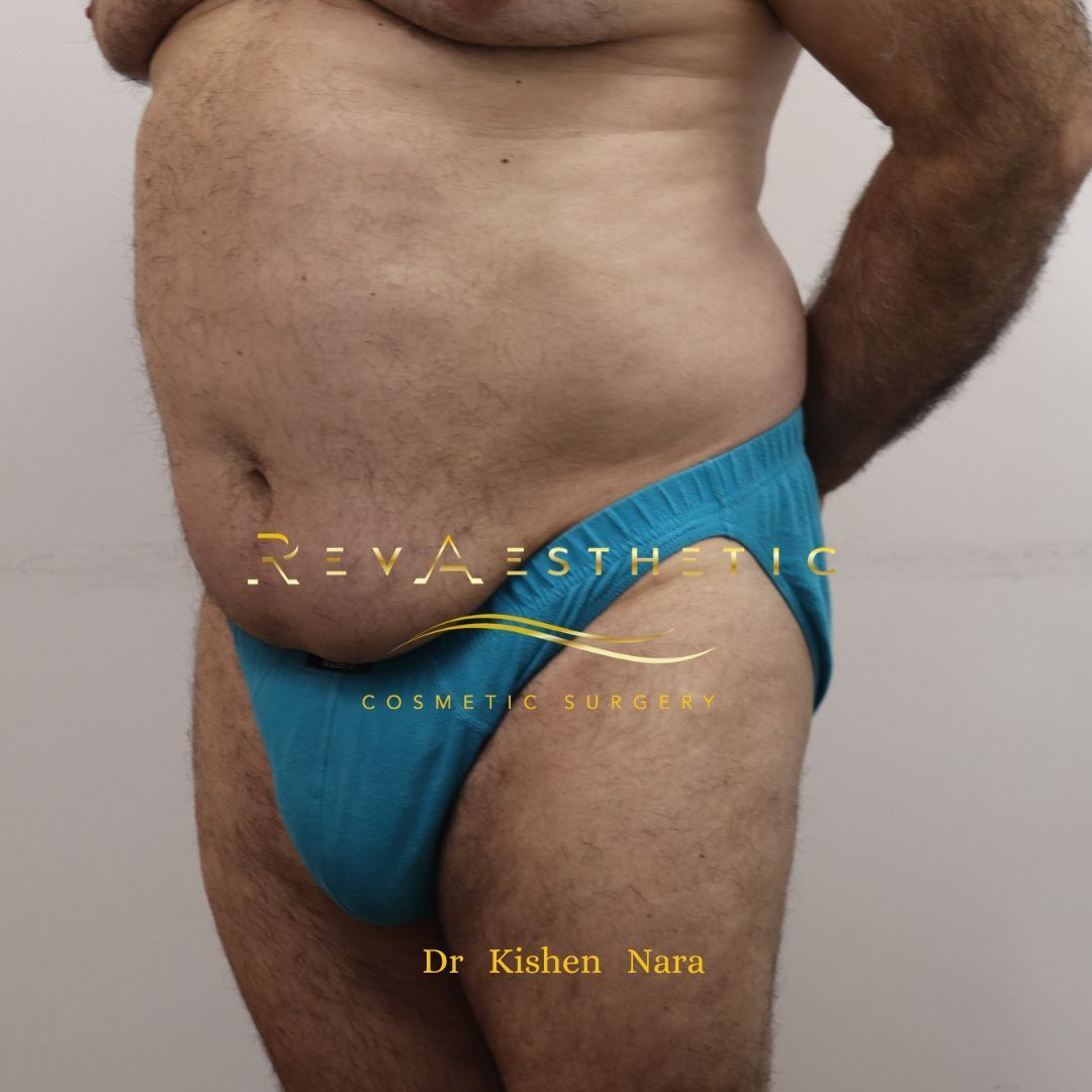 Lipo 360 in Melbourne including Richmond and Beaumaris 6 weeks after surgery by Dr Kishen Nara
