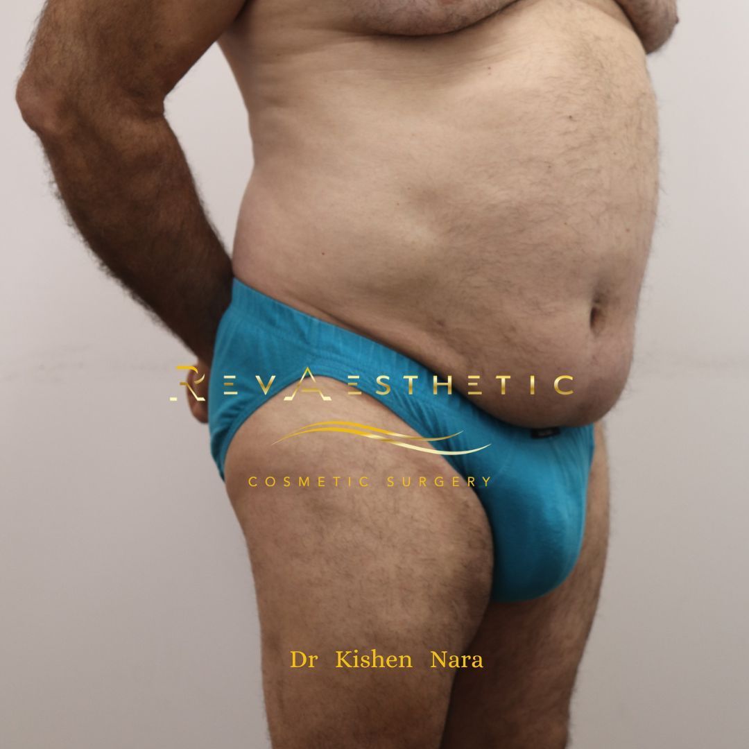 Results of lipo 360 on tummy after 6 weeks by Dr Nara at RevAesthetic in Melbourne and Tasmania