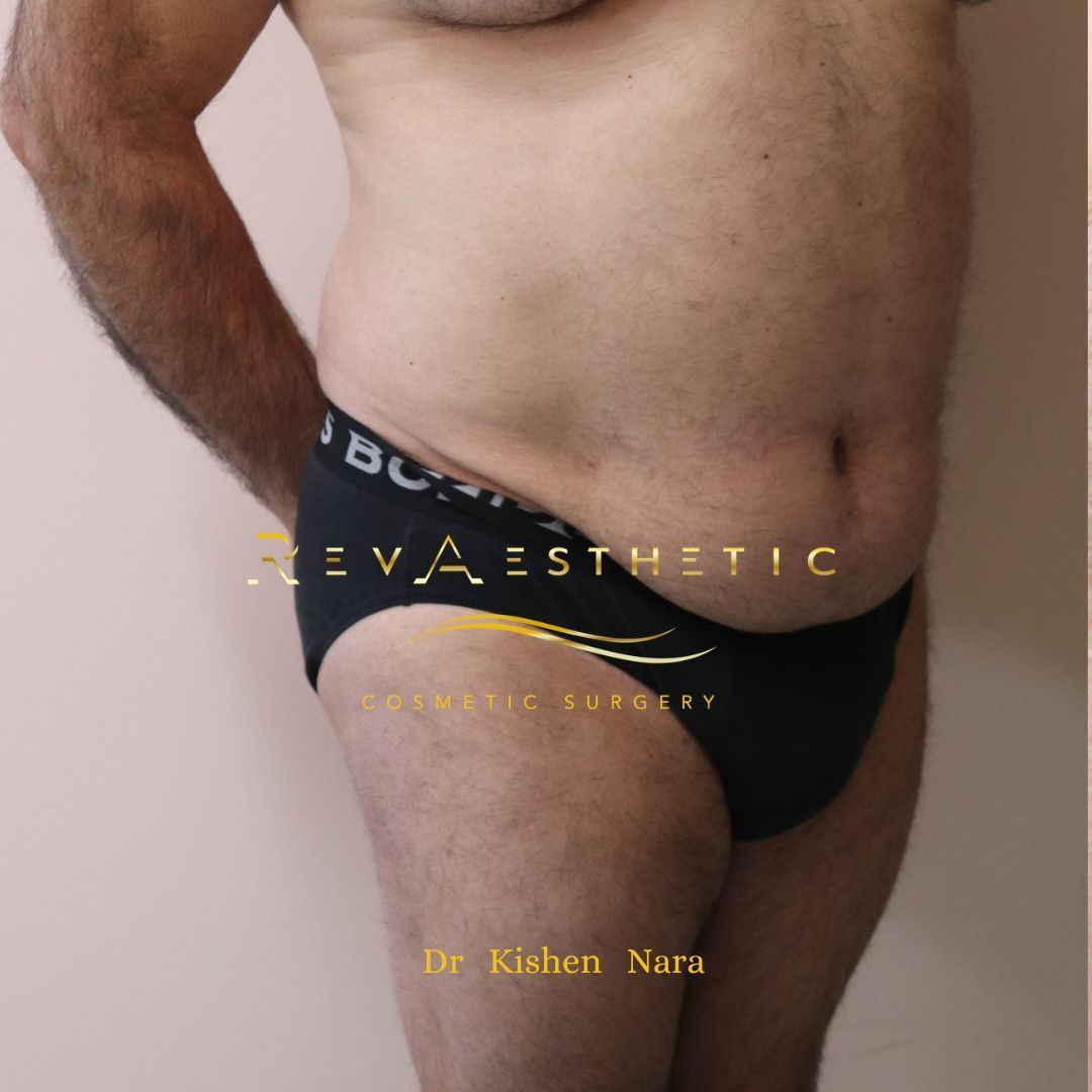 Before 360 lipo on tummy performed by Dr Nara at RevAesthetic in Melbourne