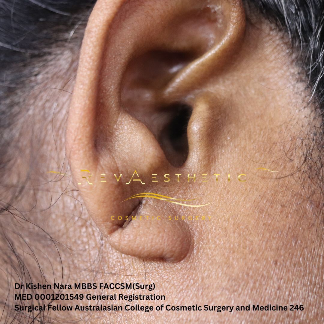 Melbourne ear lobe large defect assessment by Dr Kishen Nara in Chadstone