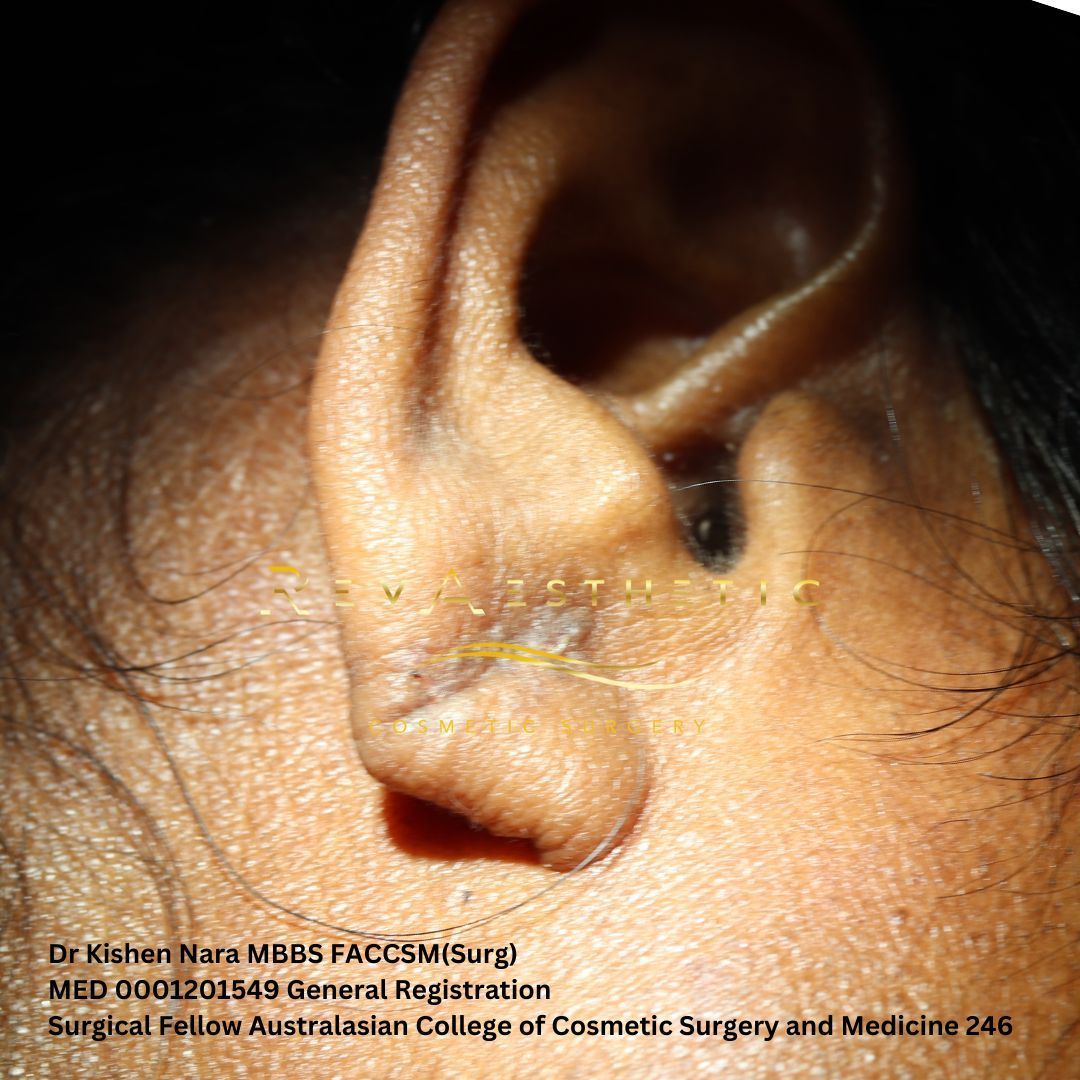 Best ear lobe repair before and after results in Melbourne by Dr Nara at RevAesthetic in Armadale