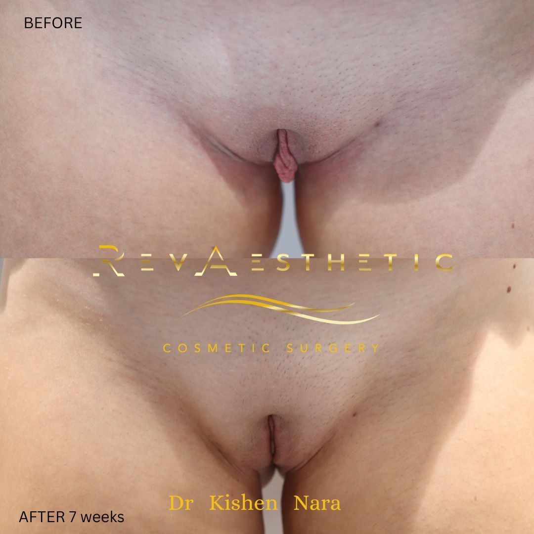 Top SAP labiaplasty minora and clitoral hood reduction recovery in Adelaide and Glenelg by Dr Kishen Nara