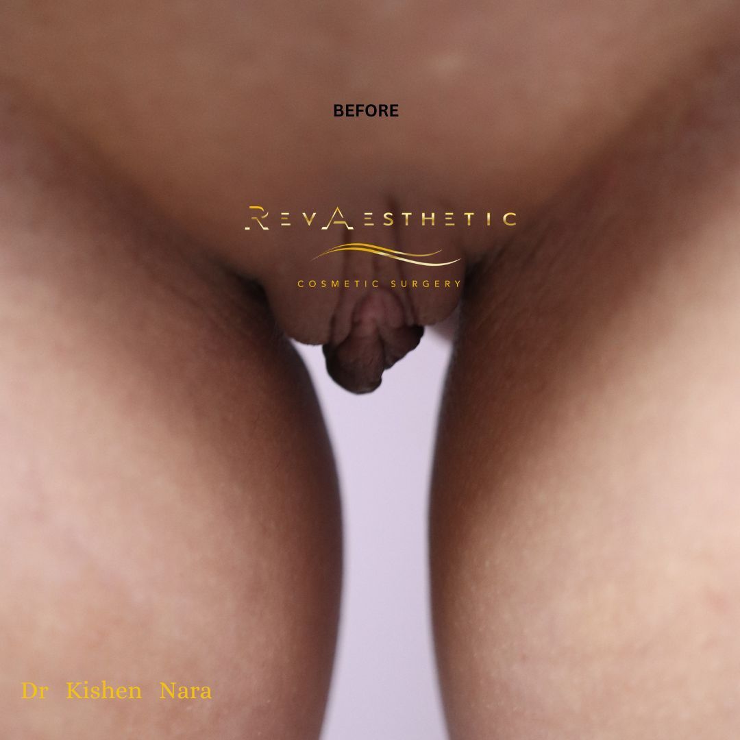 Before SAP labiaplasty for labia minora, labia majora and clitoral hood in Hobart by Dr Nara RevAesthetic team.