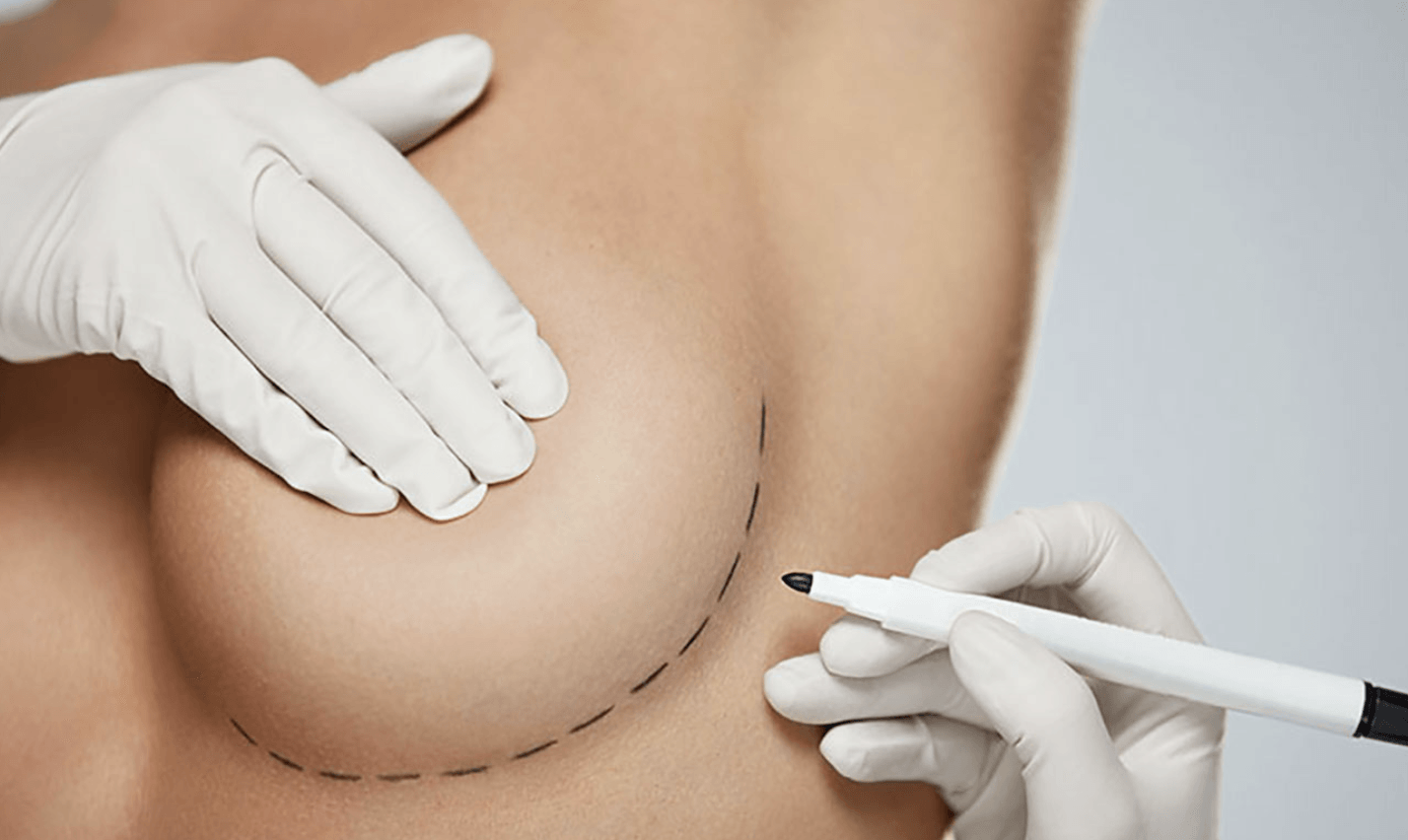 top best Breast lift mastopexy tas tasmania surgeon