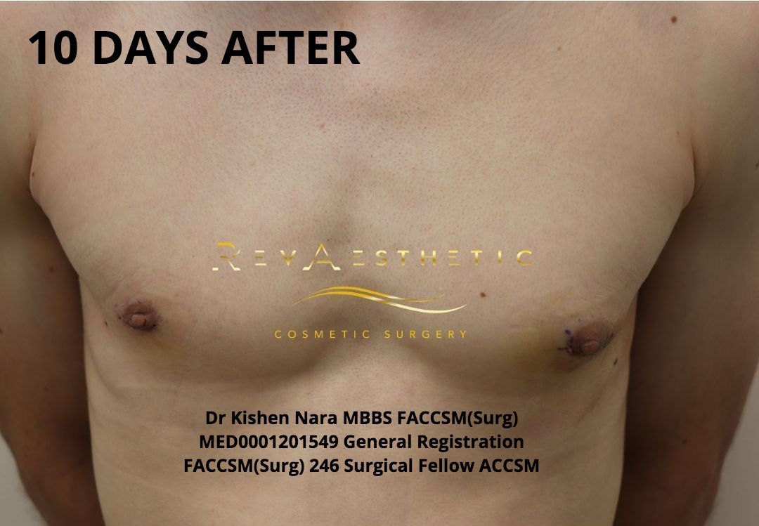 best gynaecomastia male breast reduction surgery melbourne tasmania hobart devonport burnie st kilda elwood brighton cosmetic plastic surgery