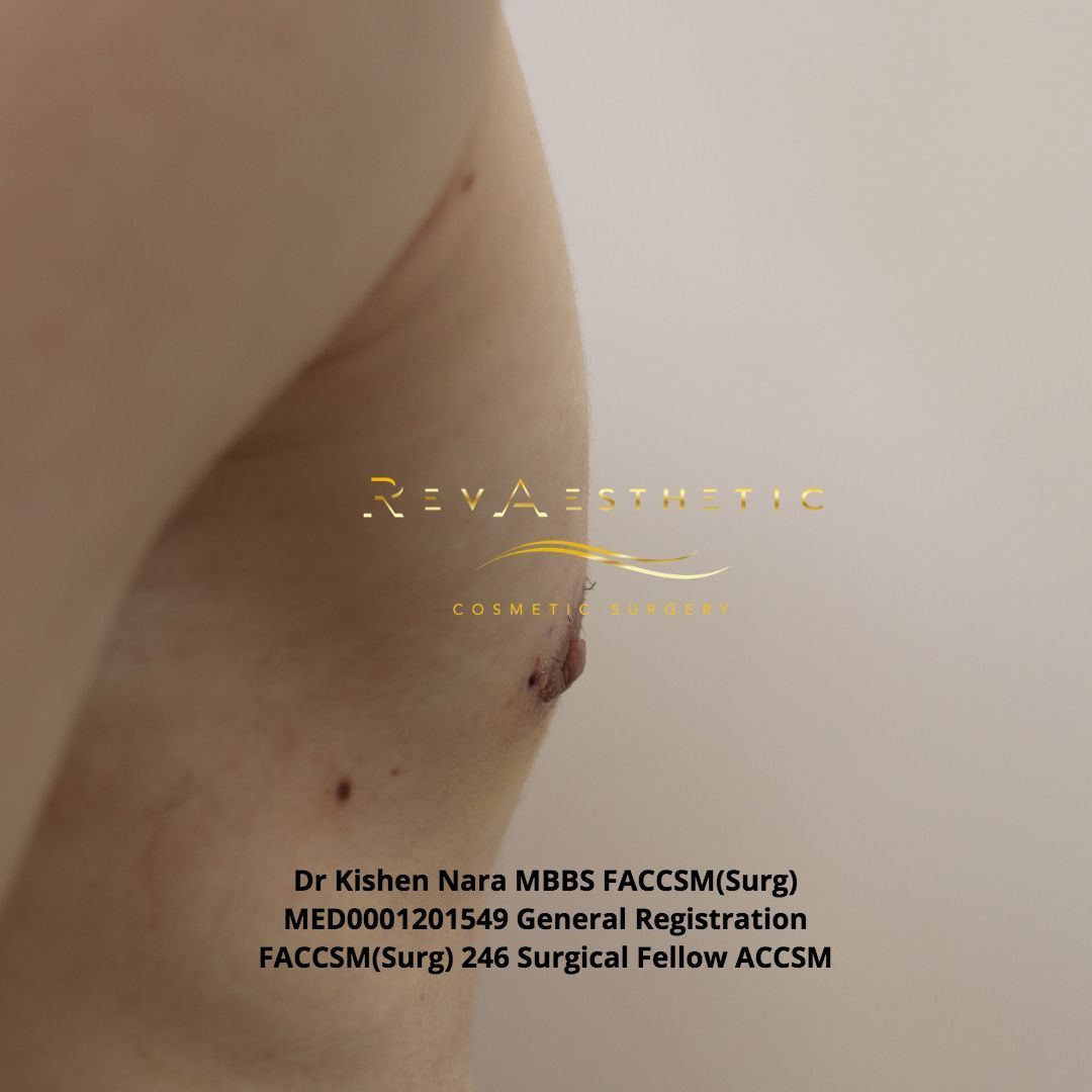 Gynaecomastia male man breast reduction reduce fat skin chest pecs surgery operation melbourne st kilda brighton cosmetic surgery